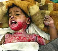 Photo of child, badly injured by military incursion